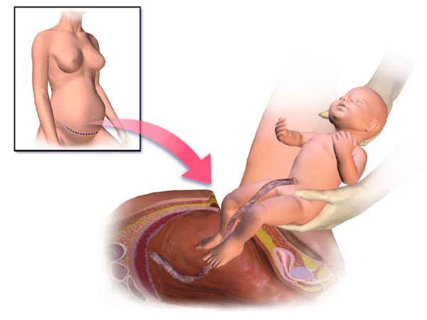 rupture pregnancy5