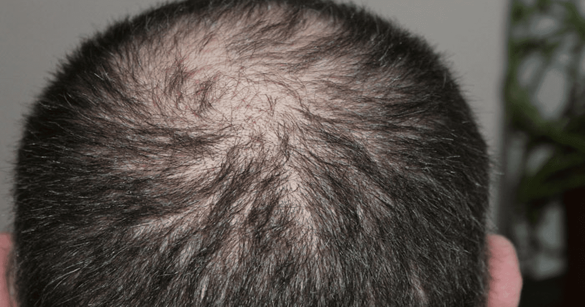 People Who Suffer From Hair Loss Can Eat These 9 Foods To Reverse The Process