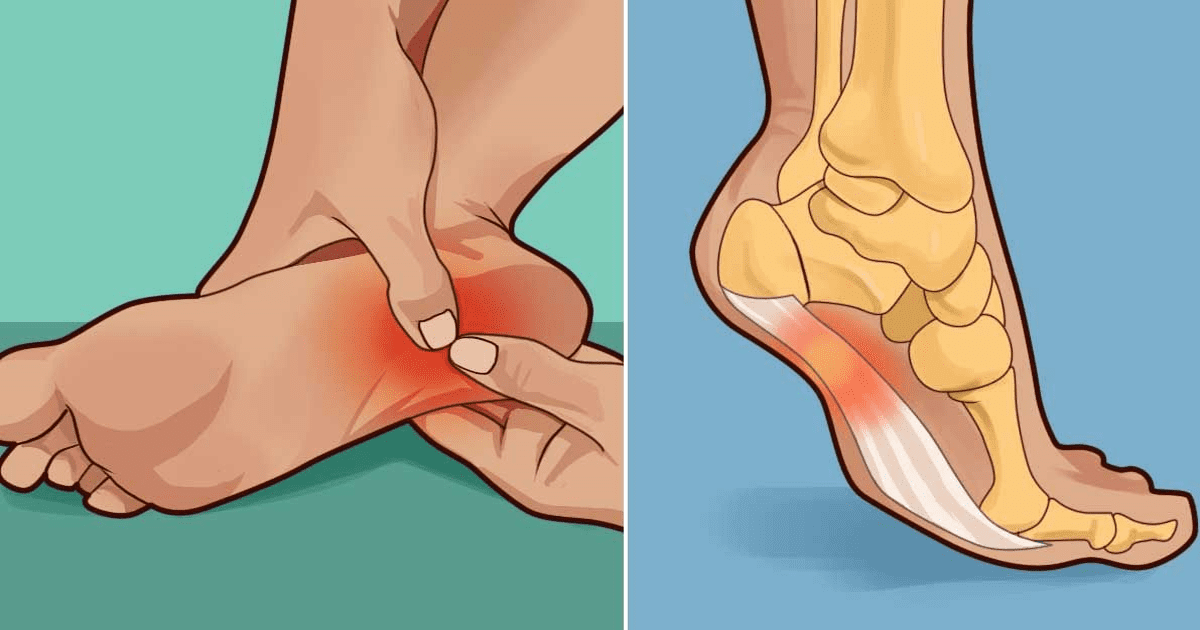 Remedies To Help Prevent And Treat Plantar Fasciitis
