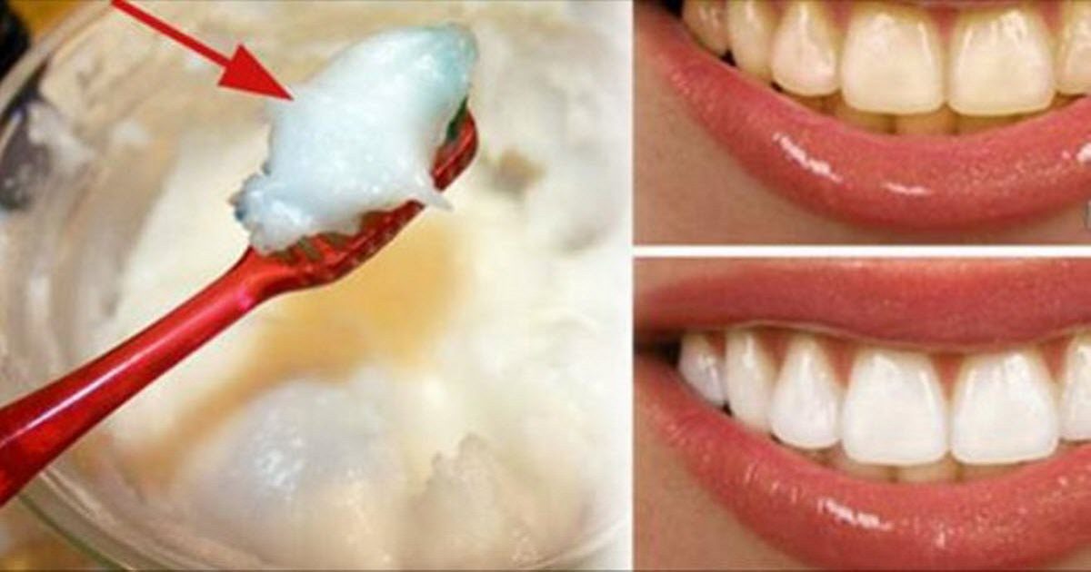 Reverse Cavities And Heal Decomposed Teeth With Coconut Oil