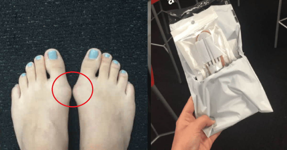 Woman Decided To Sleep In Bunion Splints For 7 Nights To Avoid Surgery