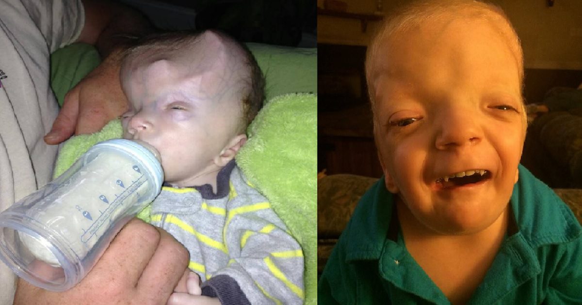 6-Year-Old Boy Born With Grayson Disease Miraculously Survives After 36 Surguries